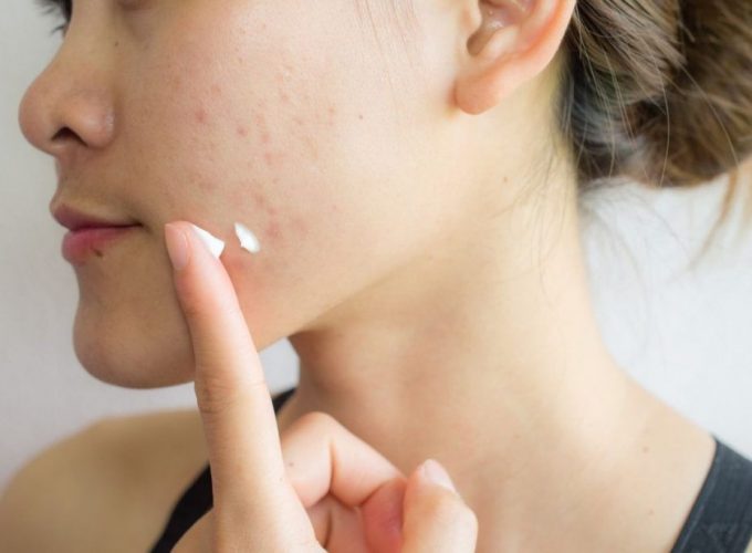 Best Face Care Products for Acne Prone Skin